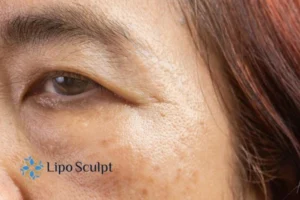 Cryopen: The Revolutionary Treatment for Age Spots Unveiled 2 Are age spots Leighton Buzzard giving you low self esteem? Contact us today!