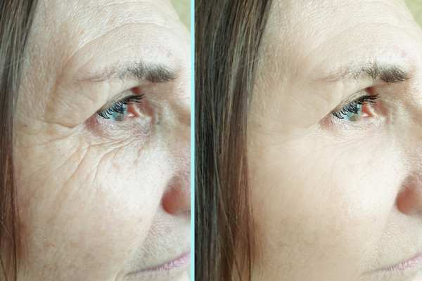 Why Do People Choose HIFU for a Non-Surgical Facelift? 4 How long can HIFU results last Leighton Buzzard?