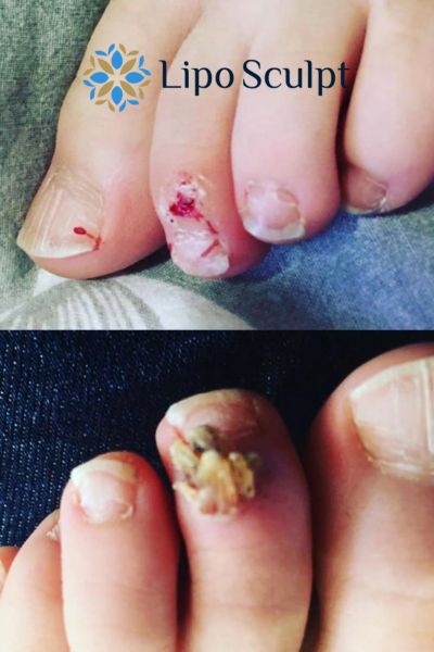 Wart removal customer results from Lipo Sculpt Leighton Buzzard